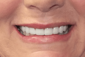 before and after dental care at Henrich Dental