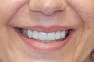 before and after dental care at Henrich Dental