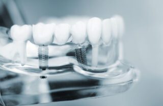 DENTAL IMPLANTS in TULSA OK can help restore your bite after losing a tooth
