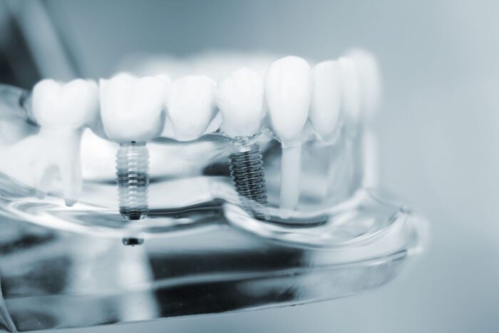 DENTAL IMPLANTS in TULSA OK can help restore your bite after losing a tooth