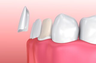 PORCELAIN VENEERS in TULSA OK could help fix a variety of imperfections in your smile