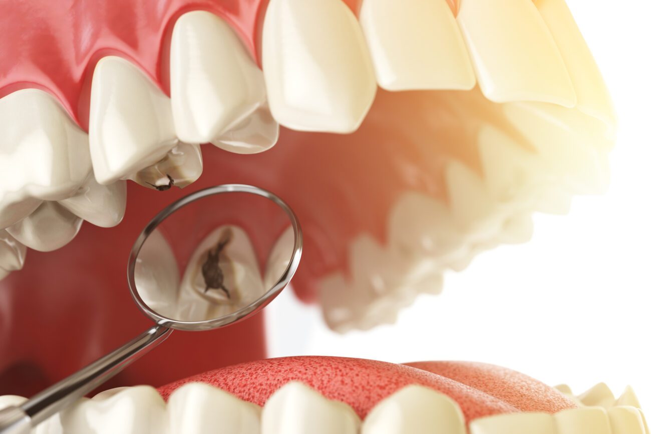 dental fillings in Tulsa, OK