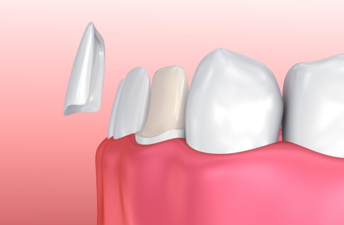 Porcelain veneers could address various dental issues, providing both cosmetic and functional improvements.