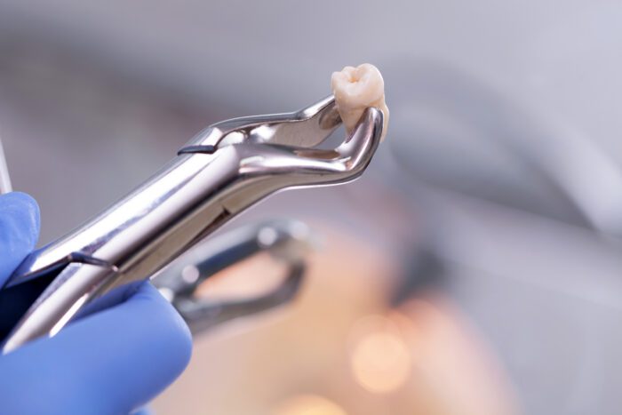 Wisdom tooth removal is a common dental procedure. Understanding each step can help ease anxiety and prepare you for your appointment.