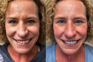 before and after dental care at Henrich Dental