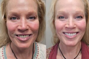 before and after dental care at Henrich Dental