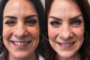 before and after dental care at Henrich Dental
