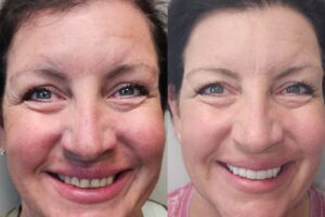 before and after dental care at Henrich Dental