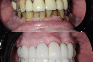 before and after dental care at Henrich Dental