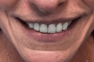 before and after dental care at Henrich Dental