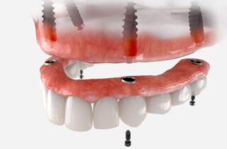 Traditional dentures often pose challenges due to discomfort and instability. All on Four dental implants effectively address these issues.