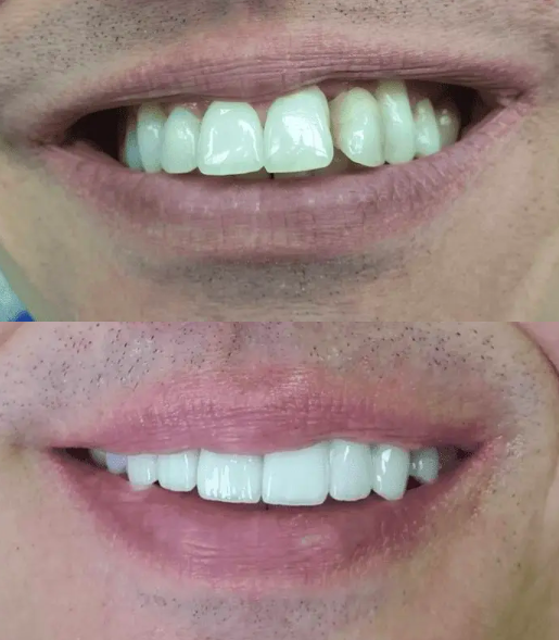 dental patient before and after porcelain veneers in Tulsa OK