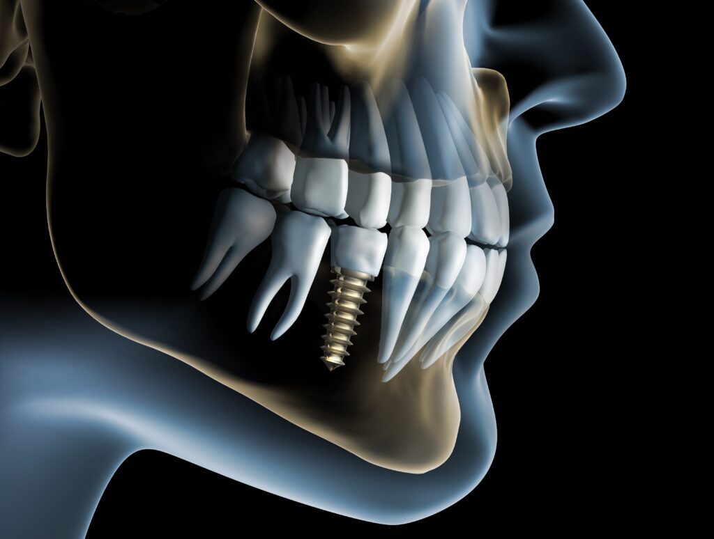 Types of dental implants Tulsa, OK