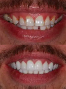 Happy patient before and after cosmetic dentistry at Henrich Dental
