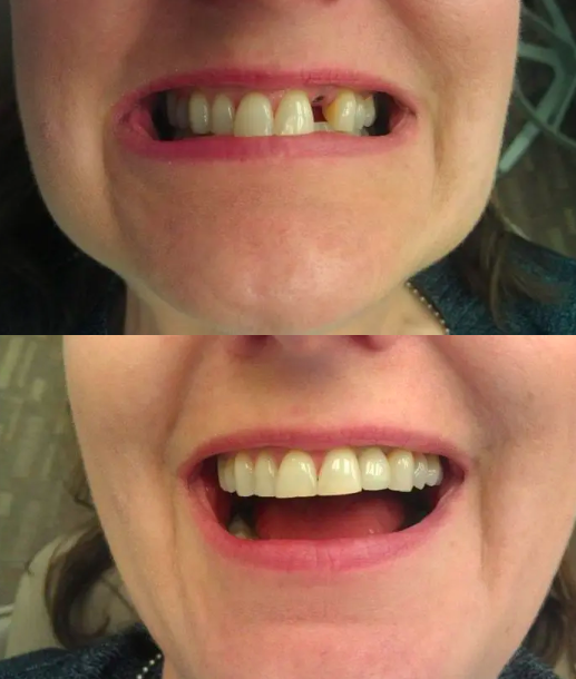 Happy patient before and after dental implants at Henrich Dental