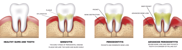 bleeding gums treatment in Tulsa OK